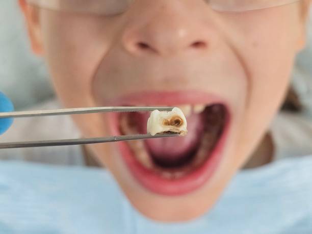 Best Emergency Treatment for Dental Infections or Abscesses in Los Angeles, CA